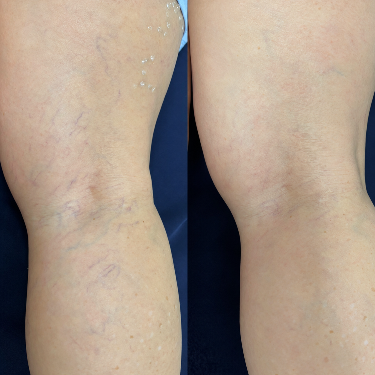 Antes e depois do tratamento de vasinhos na parte de trás da perna de uma paciente