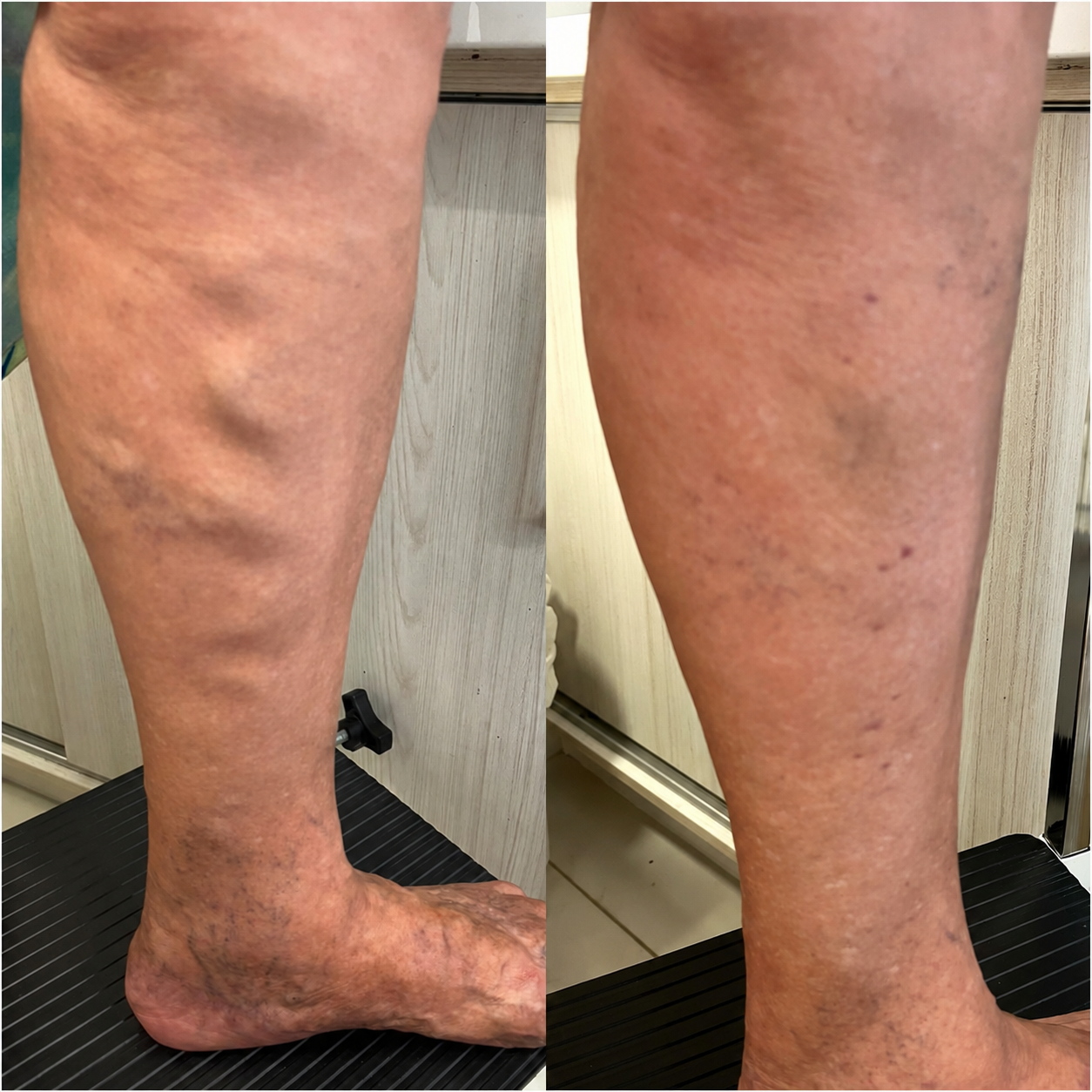Antes e depois do tratamento de varizes grossas na perna de uma paciente