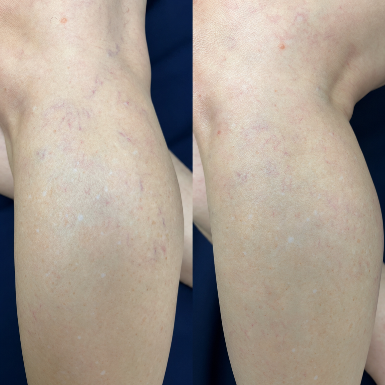 Antes e depois do tratamento de vasinhos na panturrilha de uma paciente